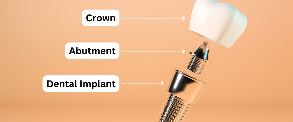 The parts of a dental implant by Jordan Landing Dental in West Jordan