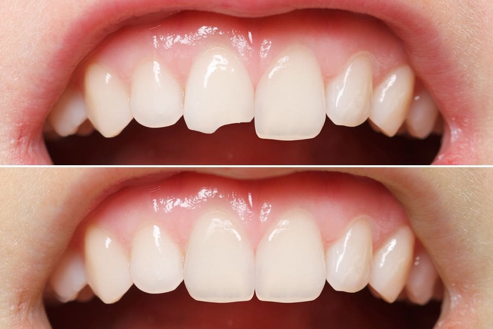 Before and after picture of a chipped tooth being repaired by dental bonding at Jordan Landing Dental Care in West Jordan, UT